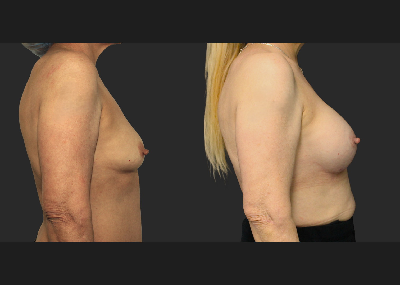 Breast Augmentation Older female 60s Subfascial over the muscle gummy silicone gel implant Natrelle SRM 345 cc