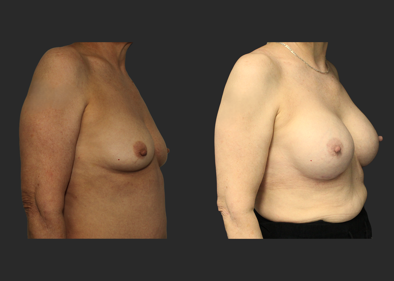 Breast Augmentation Older female 60s Subfascial over the muscle gummy silicone gel implant Natrelle SRM 345 cc