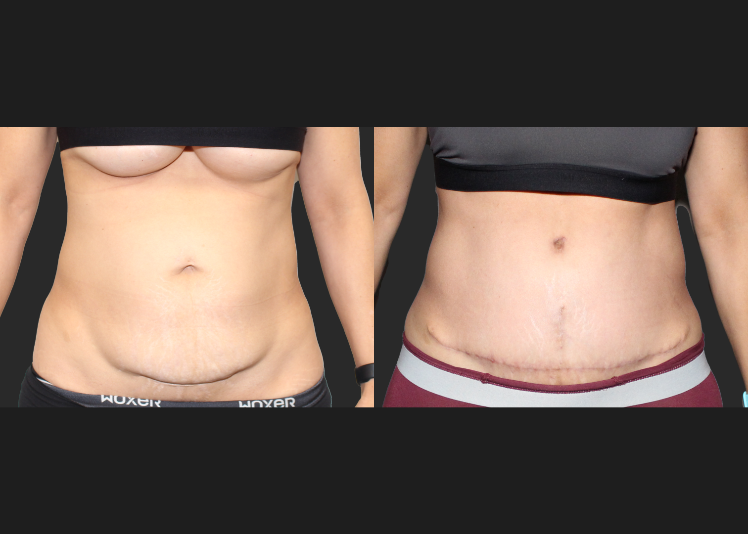 Abdominoplasty Rectus Diastasis Repair Before After 4 months_