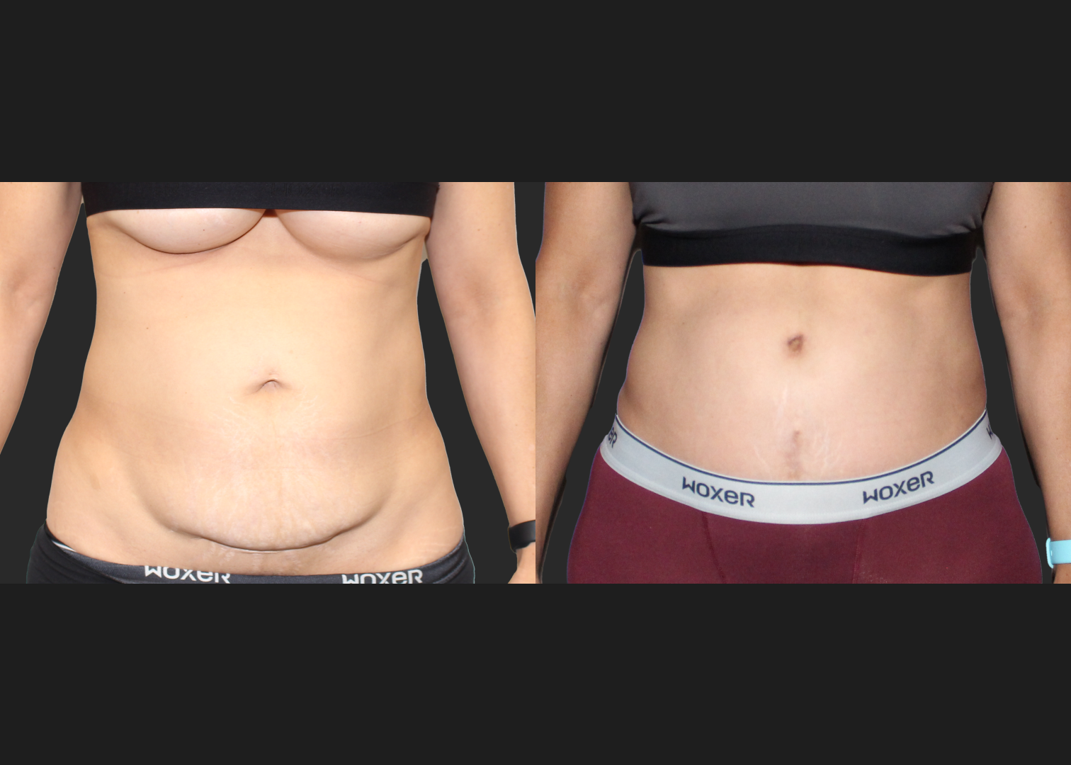 Abdominoplasty Rectus Diastasis Repair Before After 4 months_