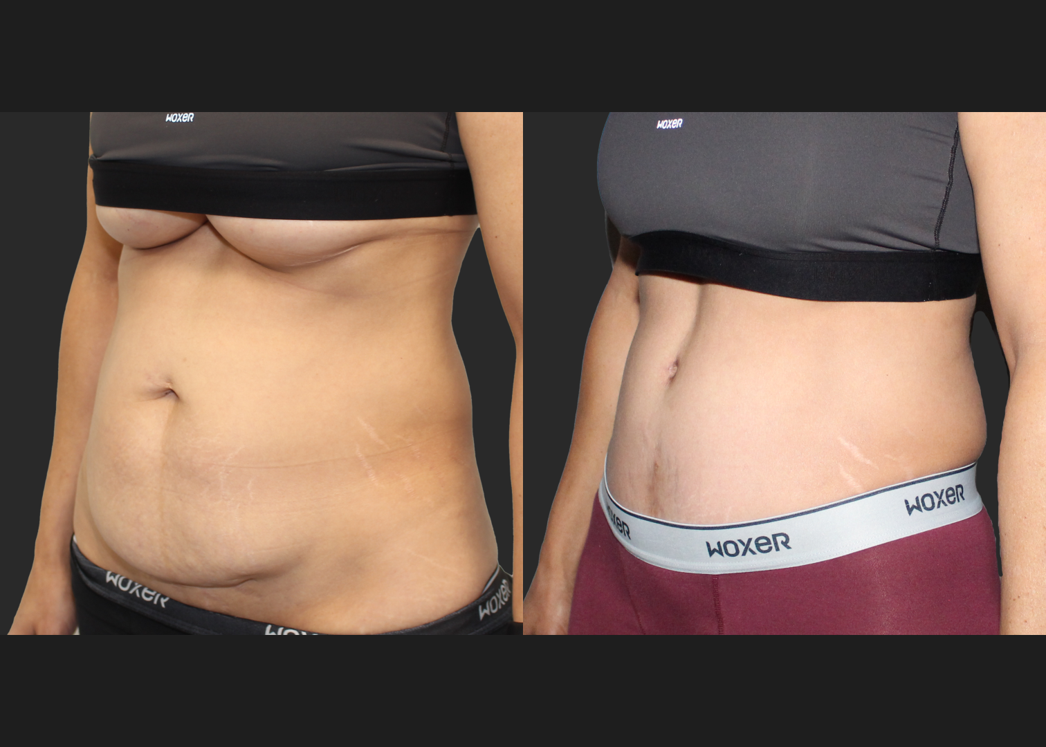 Abdominoplasty Rectus Diastasis Repair Before After 4 months_