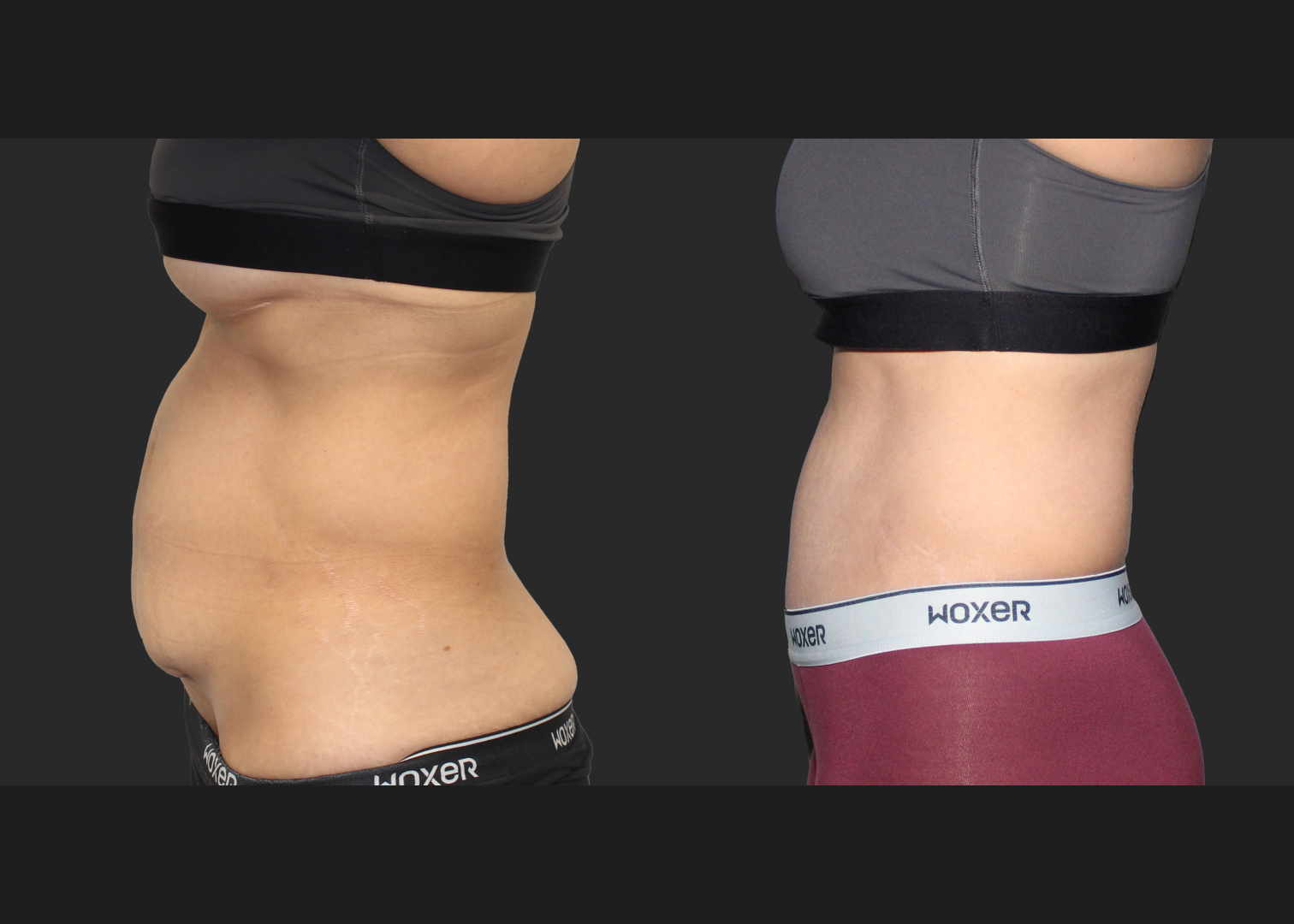 Abdominoplasty Rectus Diastasis Repair Before After 4 months_
