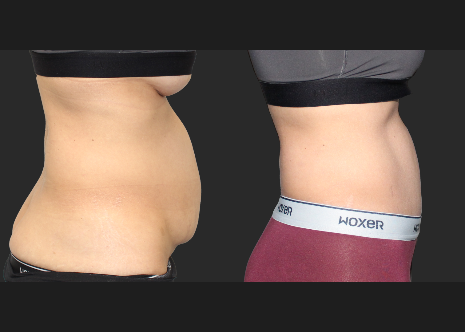 Abdominoplasty Rectus Diastasis Repair Before After 4 months_