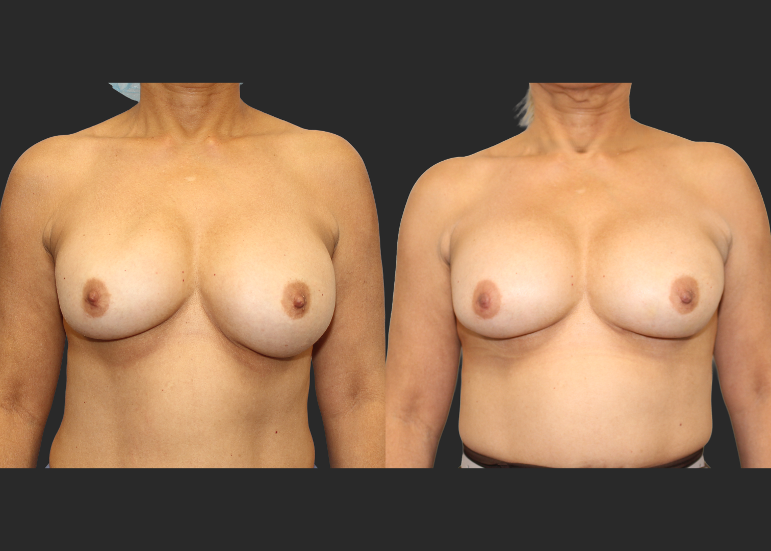 313623_Breast Implant Revision_McGhan 390cc Saline Explant_Right Partially Deflated_Allergan Inspira SRM 295cc Silicone_Bilateral Lateral Capsulorrhaphy Pocket Correction_Before and After 2 months_Front