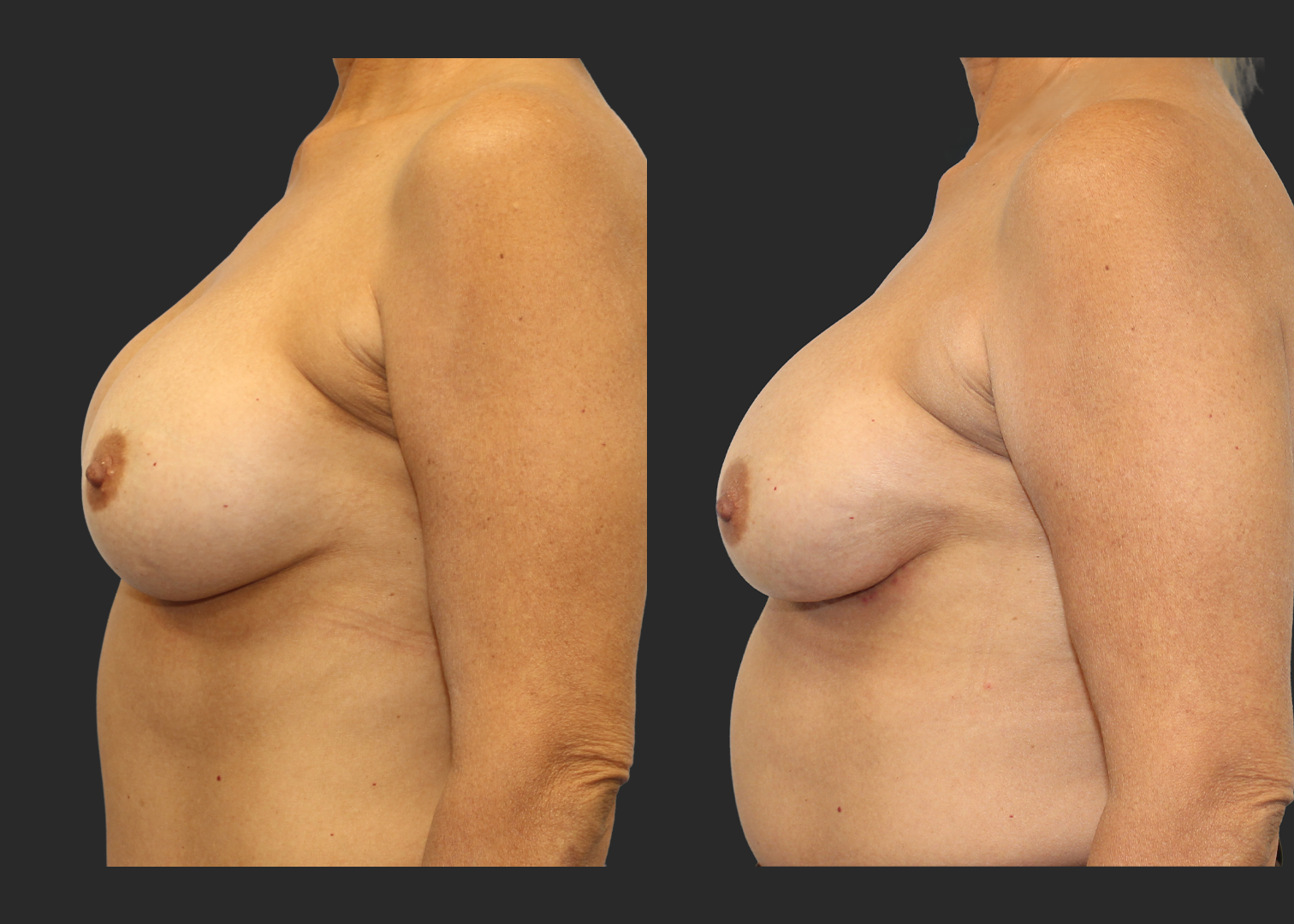 313623_Breast Implant Revision_McGhan 390cc Saline Explant_Right Partially Deflated_Allergan Inspira SRM 295cc Silicone_Bilateral Lateral Capsulorrhaphy Pocket Correction_Before and After 2 months_Front