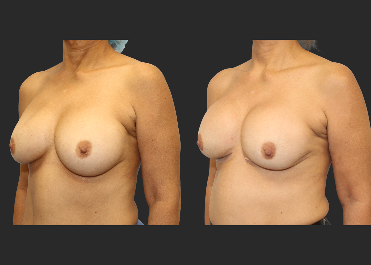 313623_Breast Implant Revision_McGhan 390cc Saline Explant_Right Partially Deflated_Allergan Inspira SRM 295cc Silicone_Bilateral Lateral Capsulorrhaphy Pocket Correction_Before and After 2 months_Front