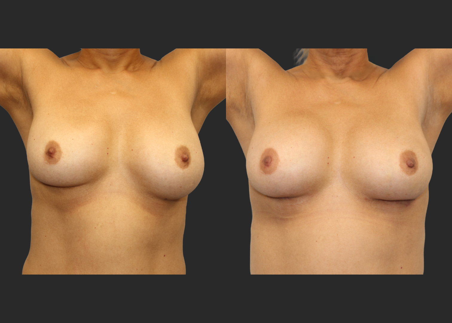 313623_Breast Implant Revision_McGhan 390cc Saline Explant_Right Partially Deflated_Allergan Inspira SRM 295cc Silicone_Bilateral Lateral Capsulorrhaphy Pocket Correction_Before and After 2 months_Front
