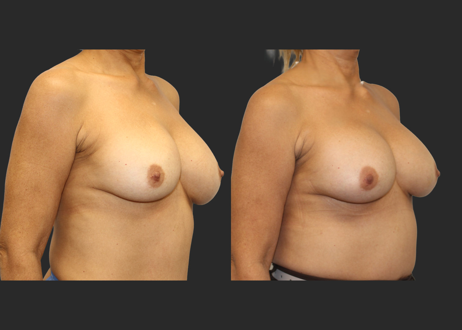 313623_Breast Implant Revision_McGhan 390cc Saline Explant_Right Partially Deflated_Allergan Inspira SRM 295cc Silicone_Bilateral Lateral Capsulorrhaphy Pocket Correction_Before and After 2 months_Front