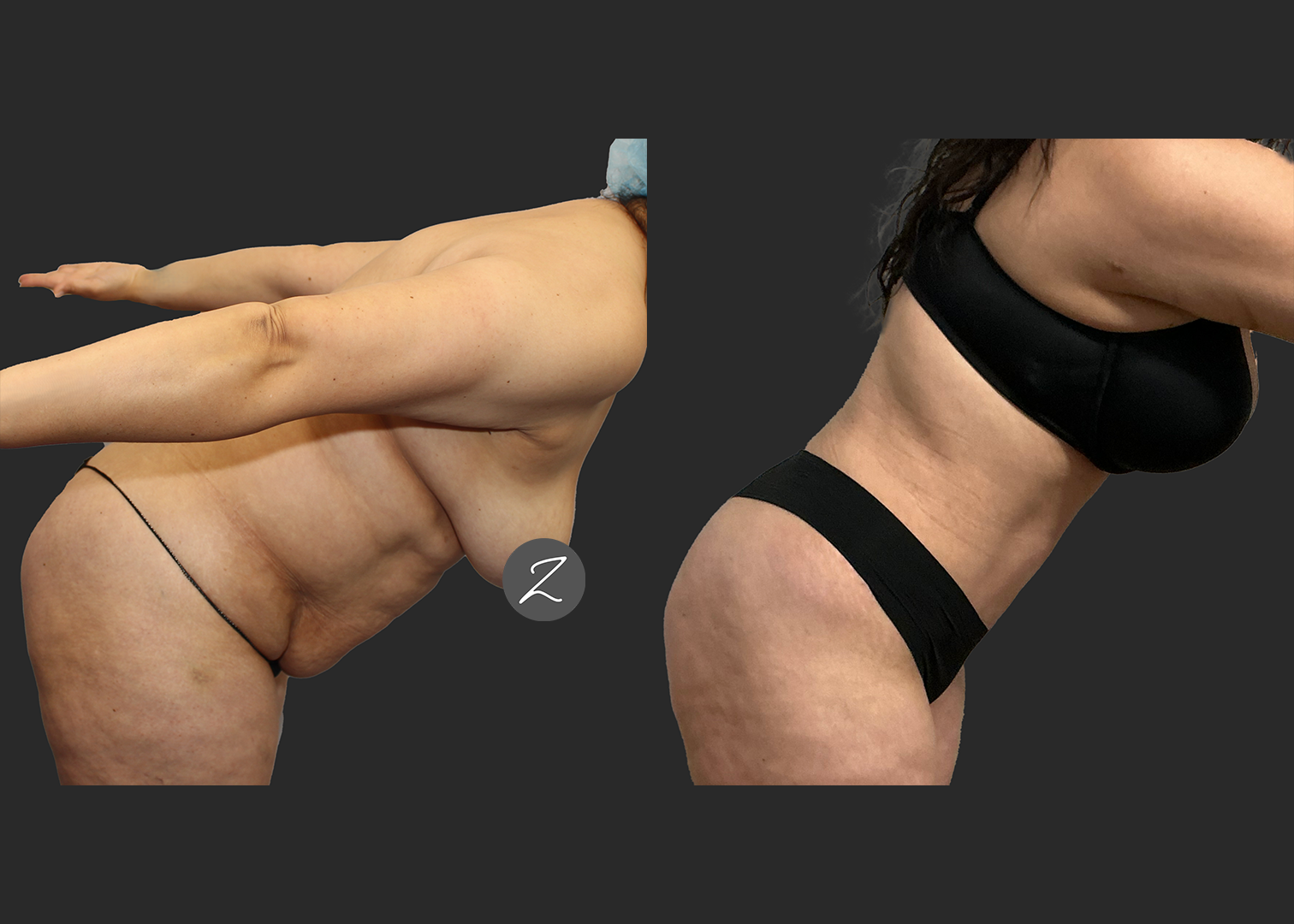 Abdominoplasty Lipo 360 Lipo Arms Renuvion Back and Arms_ Before After_ back