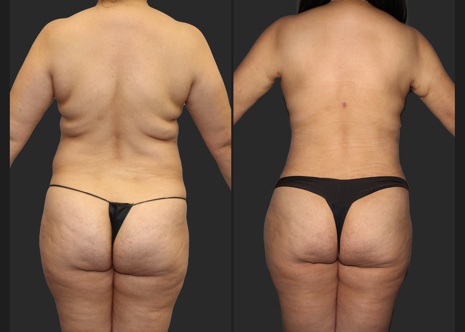 Abdominoplasty Lipo 360 Lipo Arms Renuvion Back and Arms_ Before After_ back