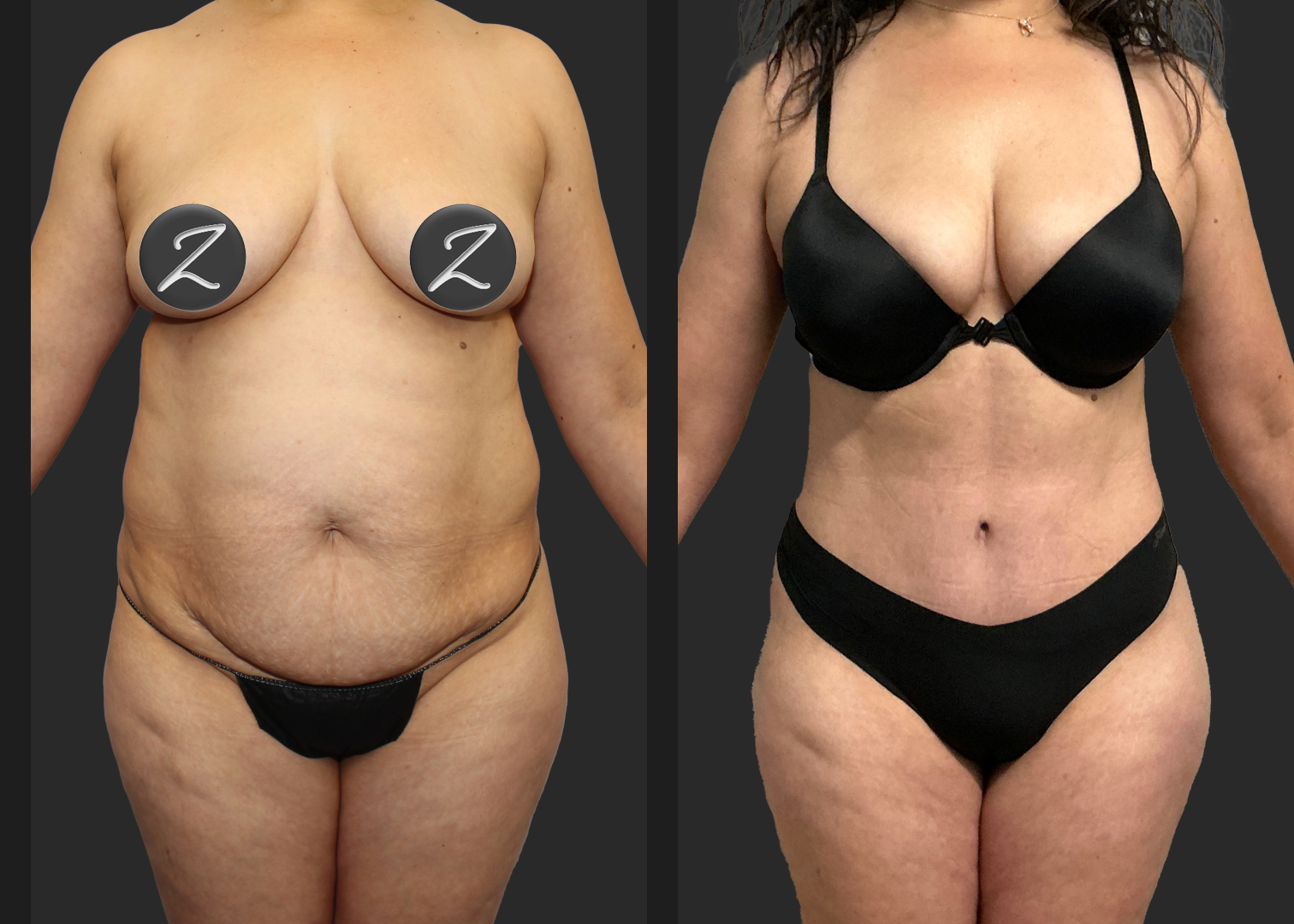 Abdominoplasty Lipo 360 Lipo Arms Renuvion Back and Arms_ Before After_ back
