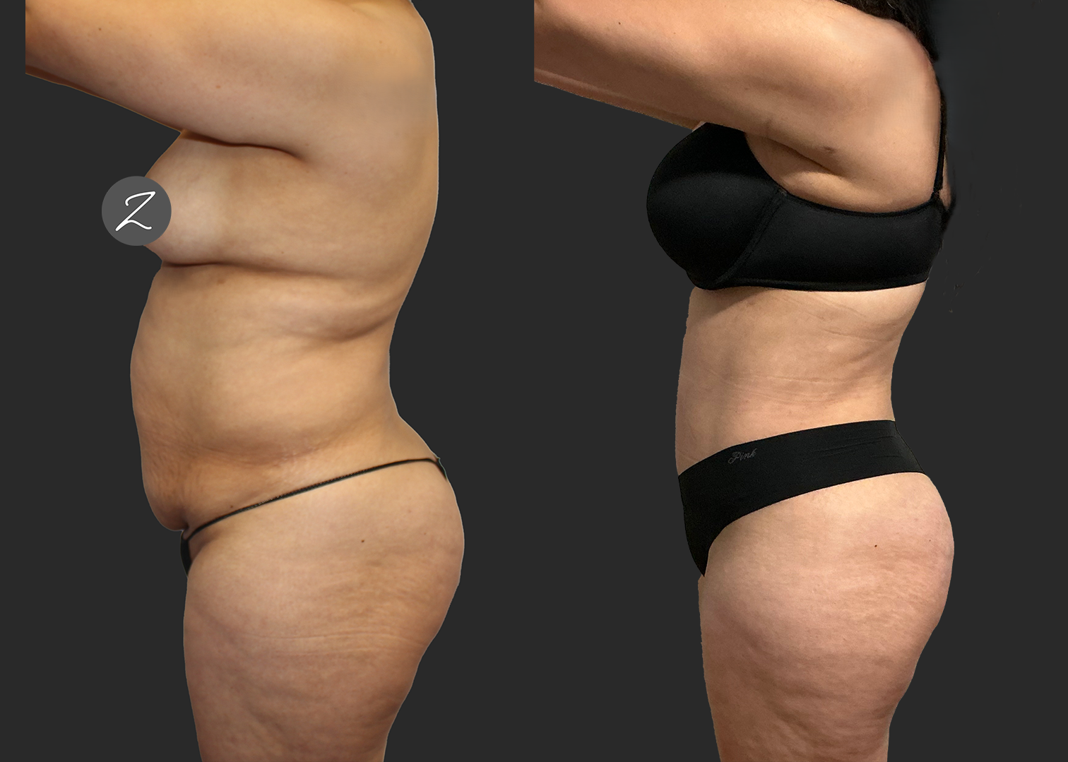 Abdominoplasty Lipo 360 Lipo Arms Renuvion Back and Arms_ Before After_ back