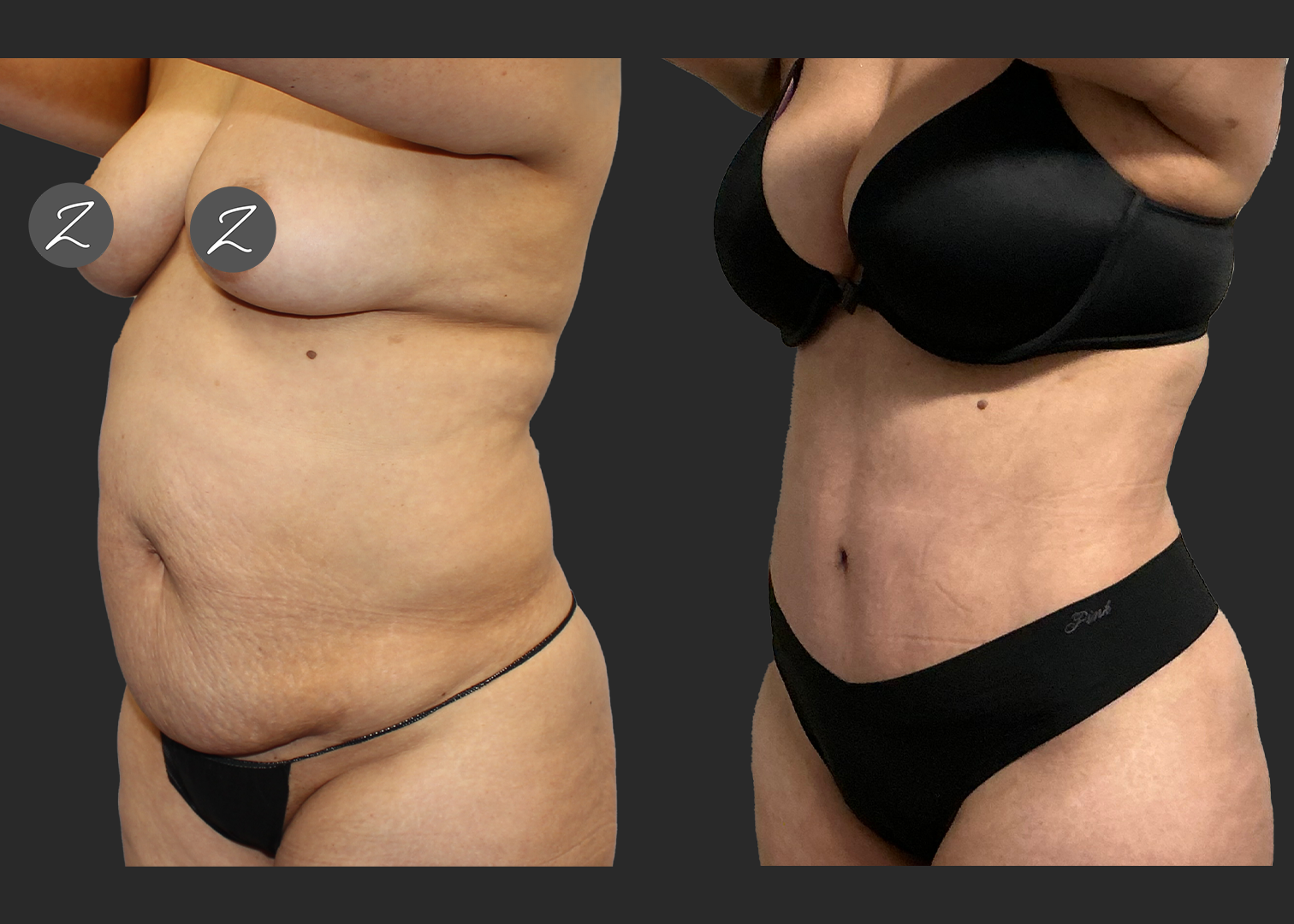 Abdominoplasty Lipo 360 Lipo Arms Renuvion Back and Arms_ Before After_ back