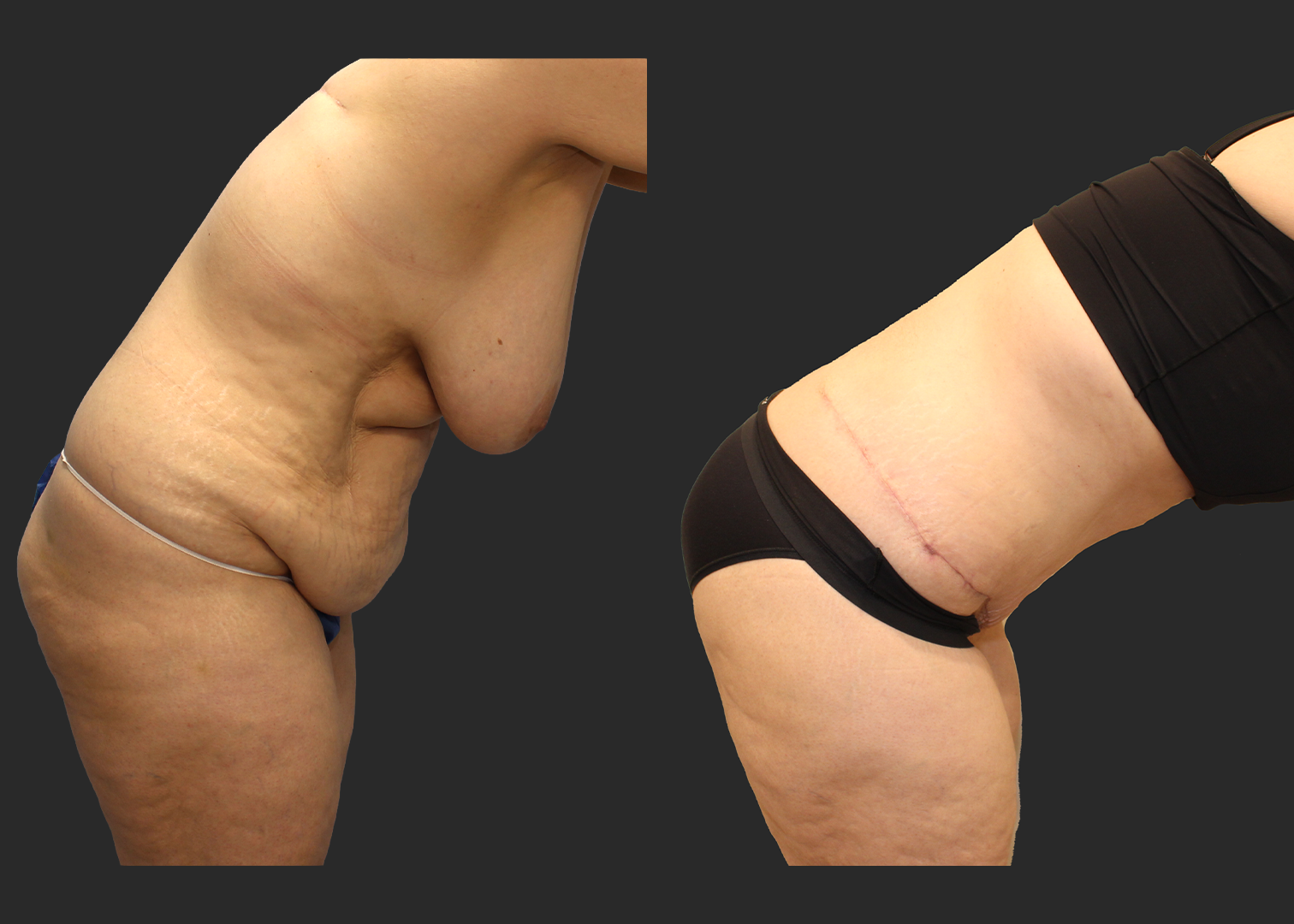 Extended Fleur-de-Lis Abdominoplasty_Flank and Lower Back Liposuction_Ventral Hernia Repair_Rectus Diastasis Repair_Before and After 2 months_