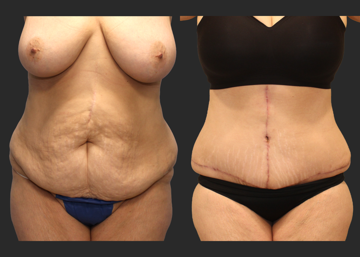 Extended Fleur-de-Lis Abdominoplasty_Flank and Lower Back Liposuction_Ventral Hernia Repair_Rectus Diastasis Repair_Before and After 2 months_