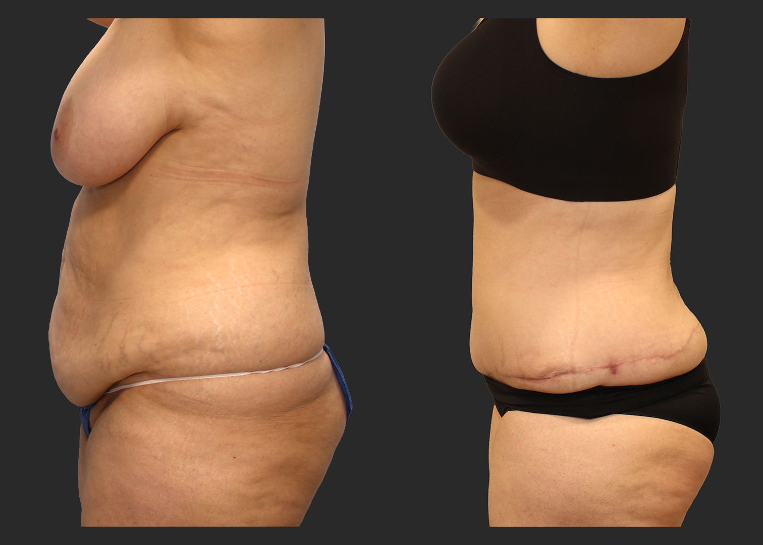 Extended Fleur-de-Lis Abdominoplasty_Flank and Lower Back Liposuction_Ventral Hernia Repair_Rectus Diastasis Repair_Before and After 2 months_