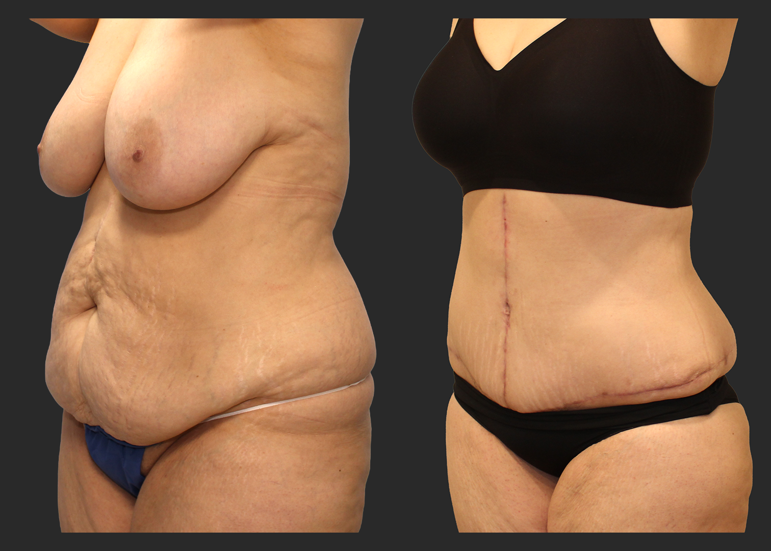 Extended Fleur-de-Lis Abdominoplasty_Flank and Lower Back Liposuction_Ventral Hernia Repair_Rectus Diastasis Repair_Before and After 2 months_