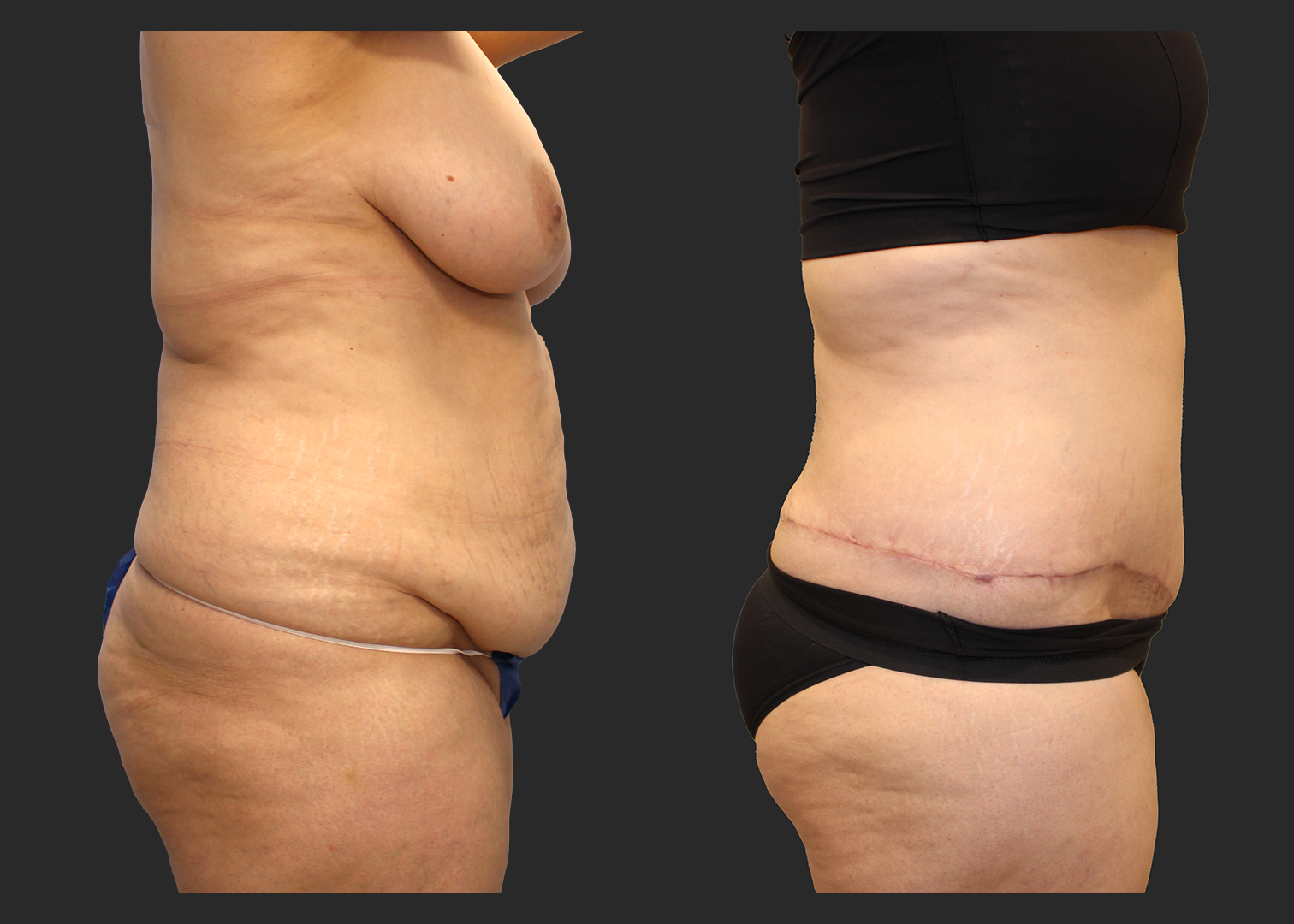 Extended Fleur-de-Lis Abdominoplasty_Flank and Lower Back Liposuction_Ventral Hernia Repair_Rectus Diastasis Repair_Before and After 2 months_