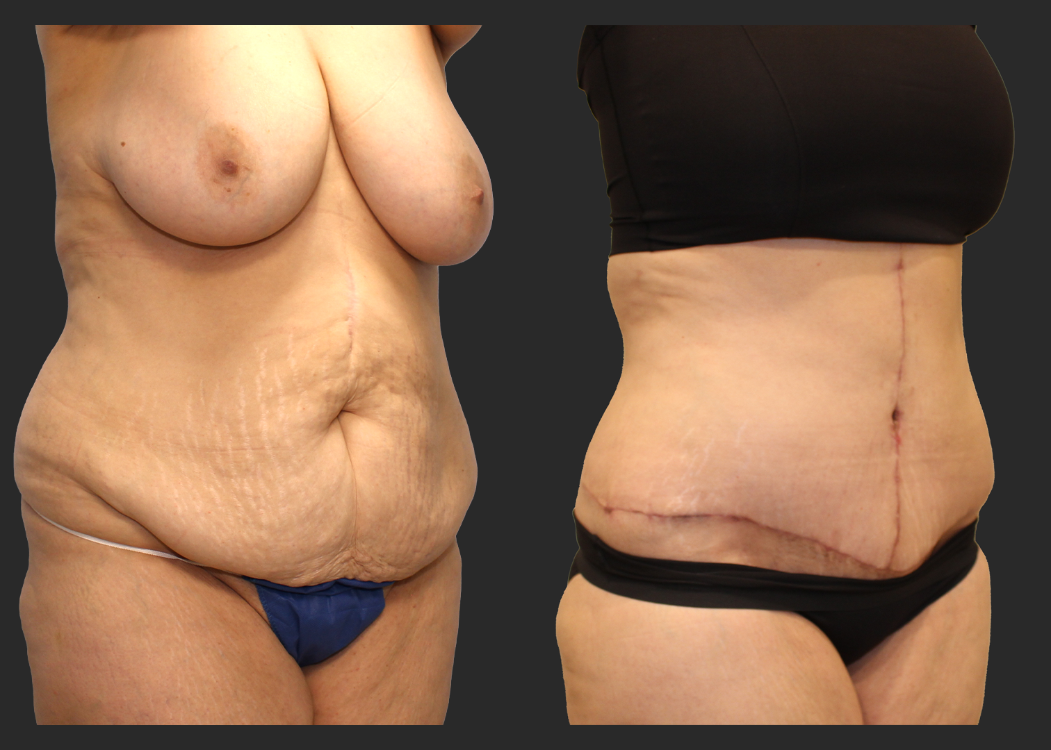 Extended Fleur-de-Lis Abdominoplasty_Flank and Lower Back Liposuction_Ventral Hernia Repair_Rectus Diastasis Repair_Before and After 2 months_