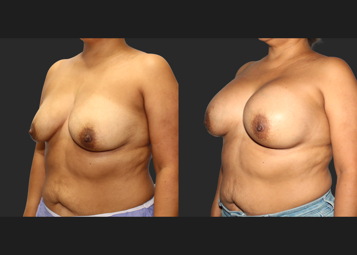 Breast Augmentation_ Saline_High profile_ 550cc_Subpectoral_Dual Plane_ Before After 5.5 weeks