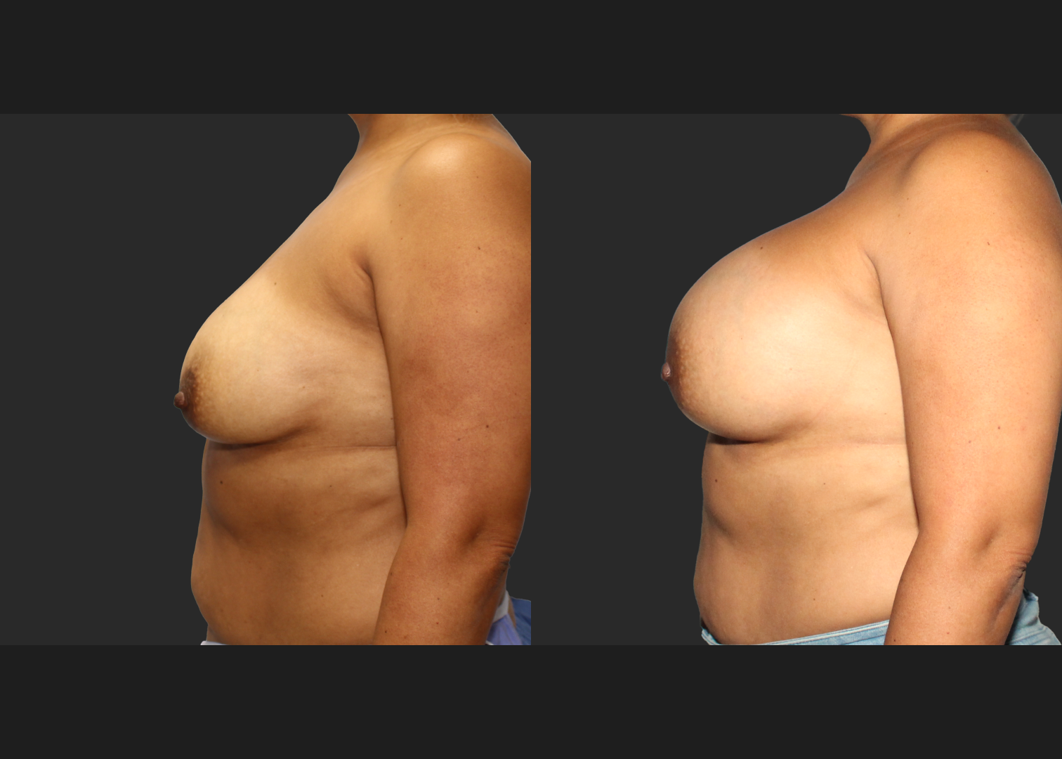 Breast Augmentation_ Saline_High profile_ 550cc_Subpectoral_Dual Plane_ Before After 5.5 weeks
