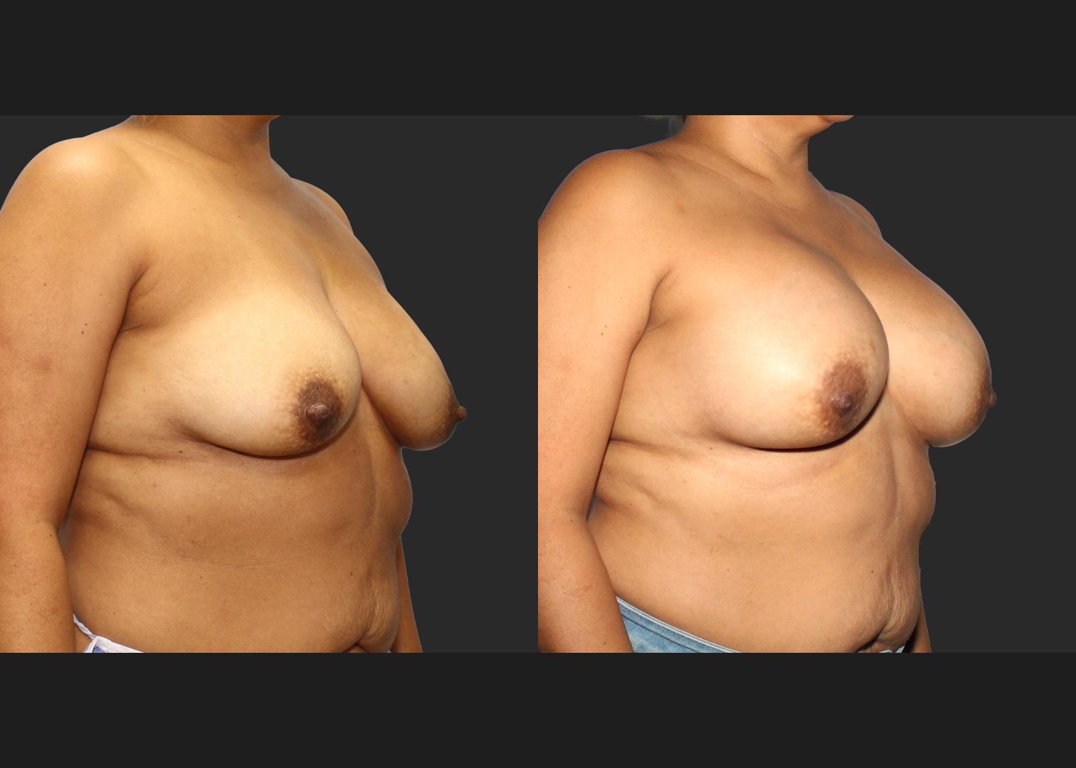 Breast Augmentation_ Saline_High profile_ 550cc_Subpectoral_Dual Plane_ Before After 5.5 weeks