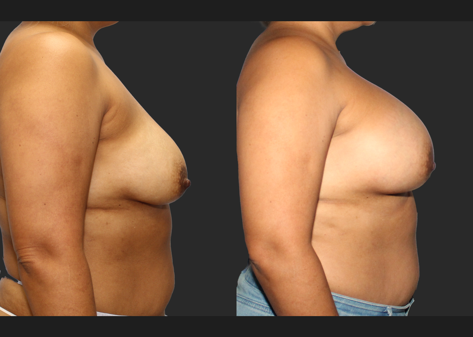 Breast Augmentation_ Saline_High profile_ 550cc_Subpectoral_Dual Plane_ Before After 5.5 weeks