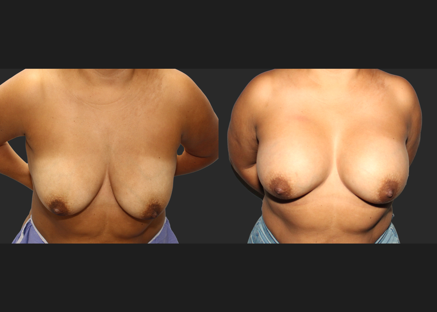 Breast Augmentation_ Saline_High profile_ 550cc_Subpectoral_Dual Plane_ Before After 5.5 weeks