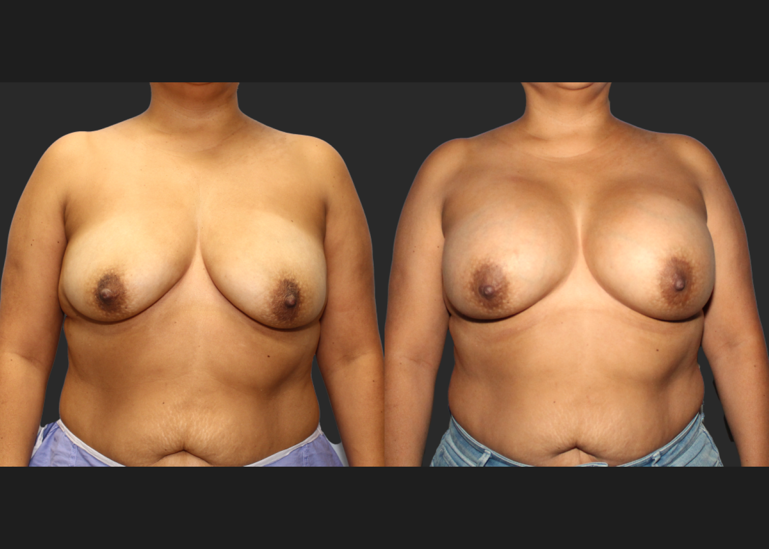Breast Augmentation_ Saline_High profile_ 550cc_Subpectoral_Dual Plane_ Before After 5.5 weeks
