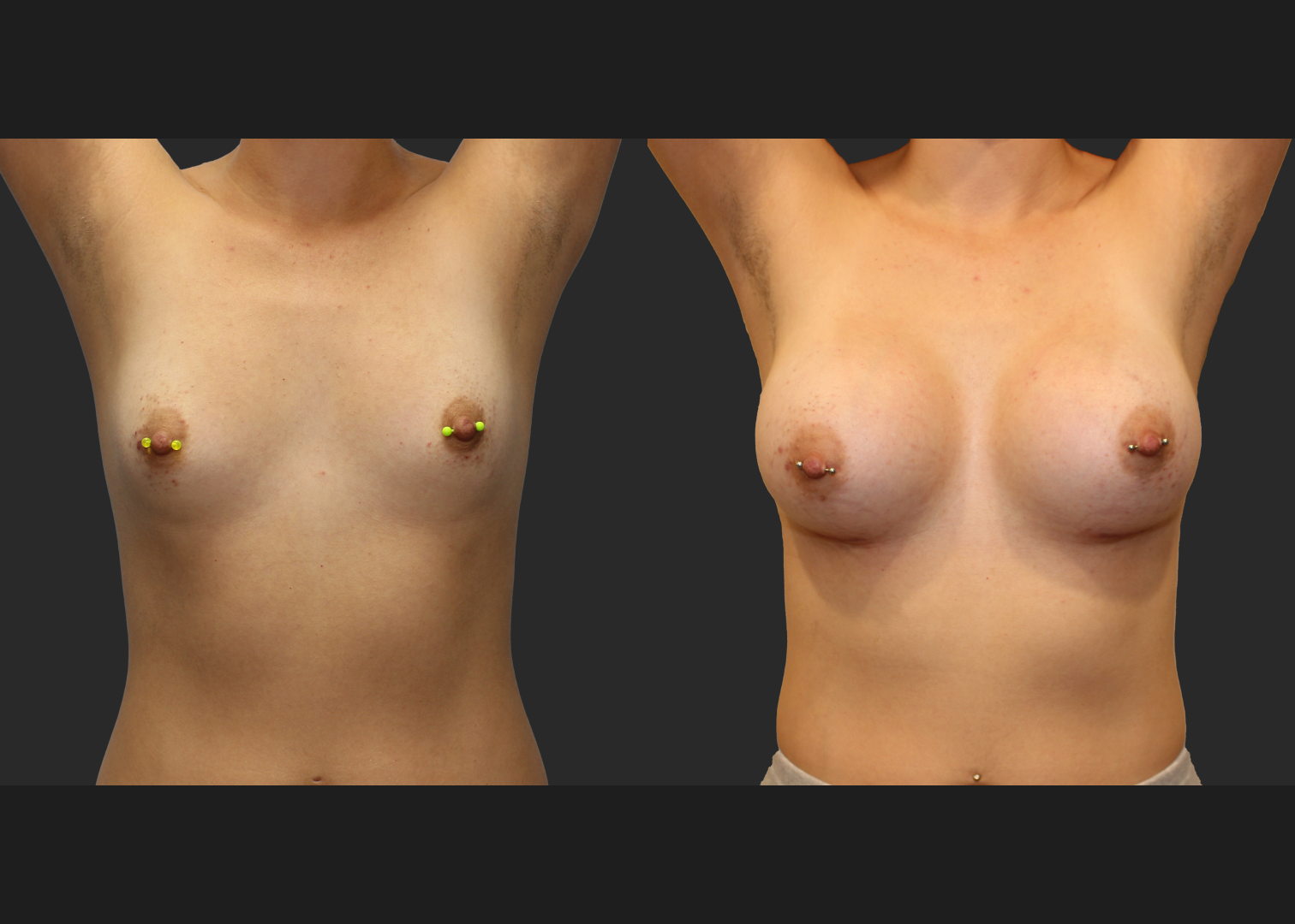 Breast Augmentation Subfascial SRX 420 cc 2 months
