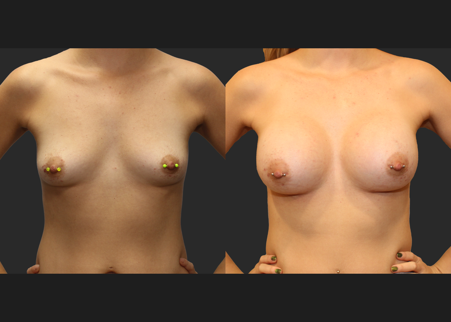 Breast Augmentation Subfascial SRX 420 cc 2 months