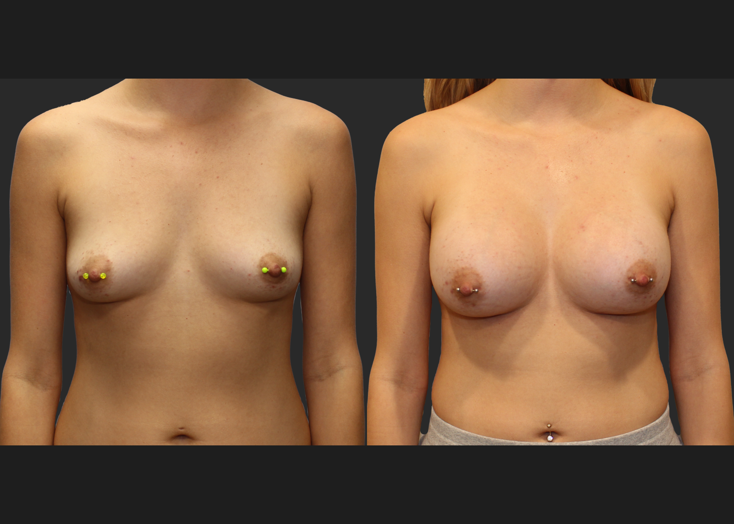 Breast Augmentation Subfascial SRX 420 cc 2 months