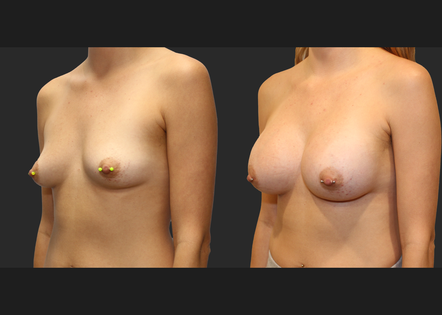 Breast Augmentation Subfascial SRX 420 cc 2 months