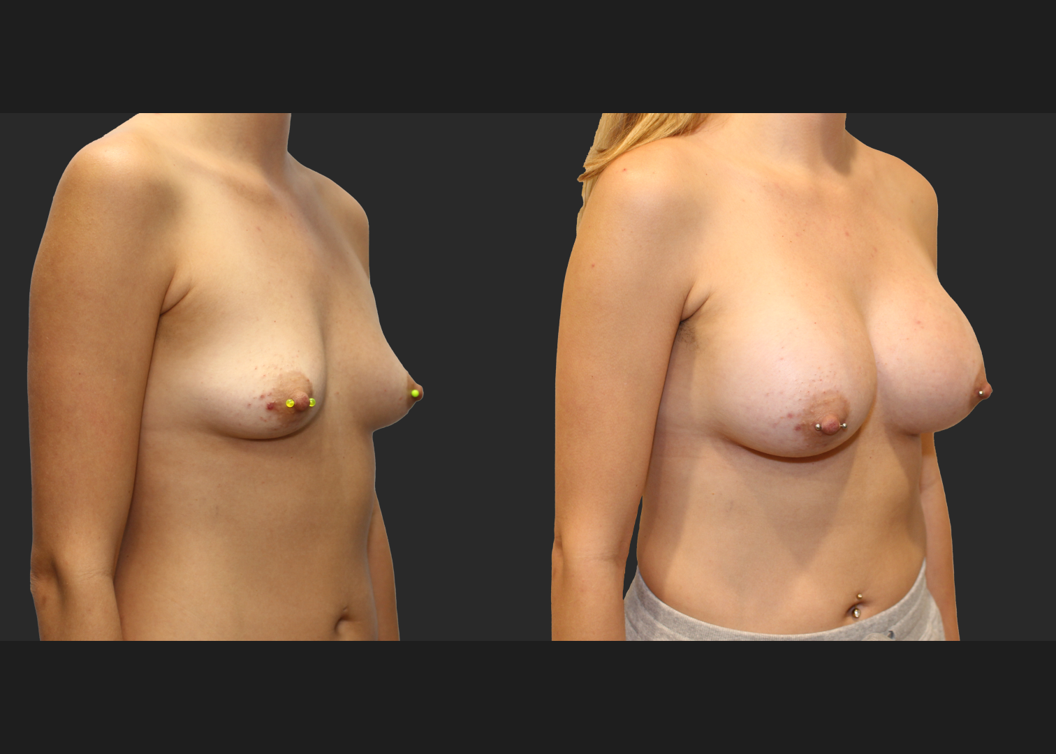 Breast Augmentation Subfascial SRX 420 cc 2 months