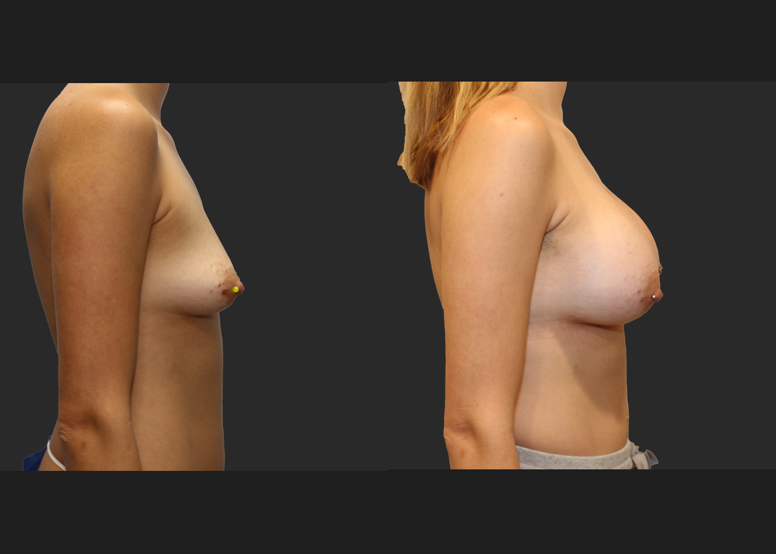 Breast Augmentation Subfascial SRX 420 cc 2 months