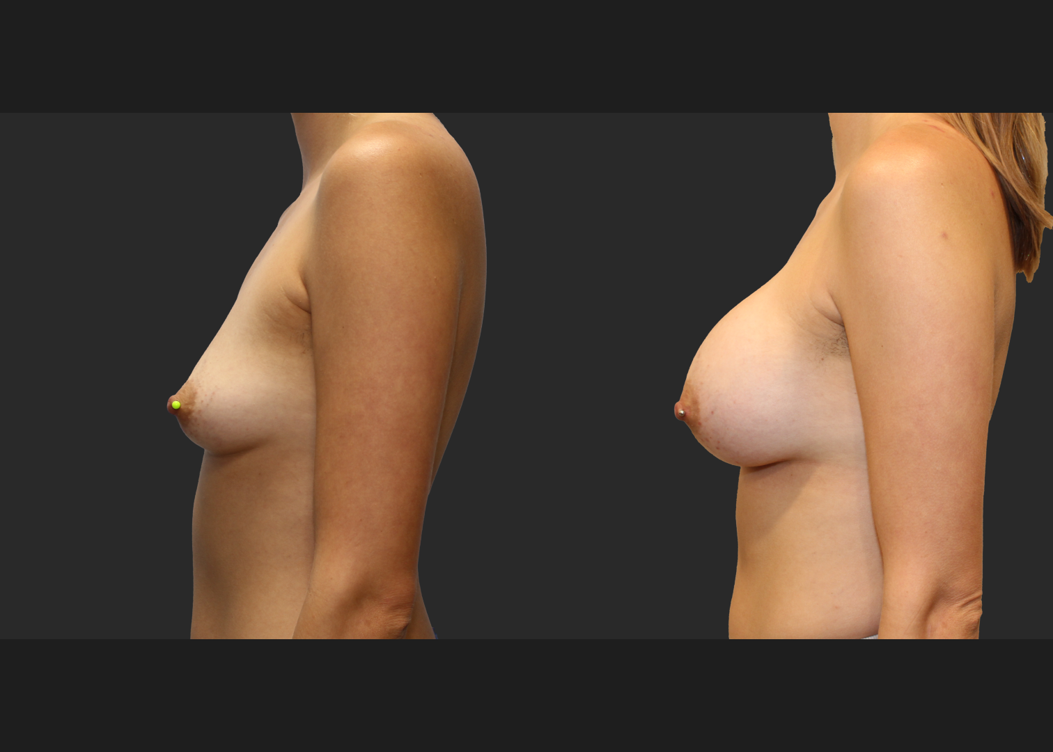 Breast Augmentation Subfascial SRX 420 cc 2 months