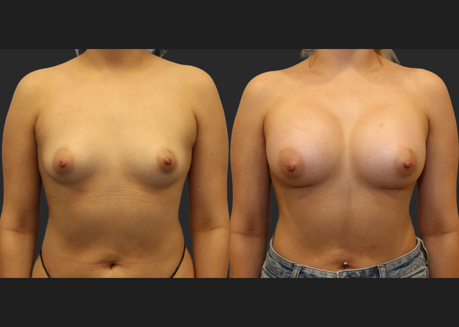 Breast Augmentation Saline Moderate profile 330 cc filled to 360 cc Subpectoral 6 weeks