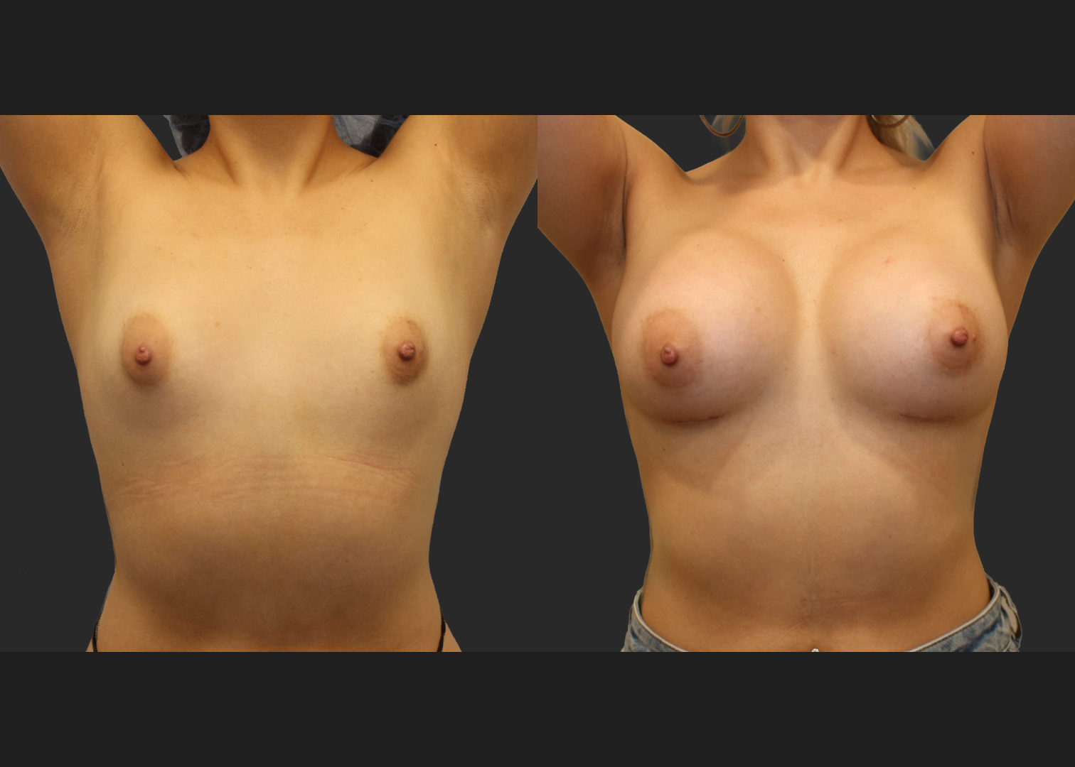 Breast Augmentation Saline Moderate profile 330 cc filled to 360 cc Subpectoral 6 weeks