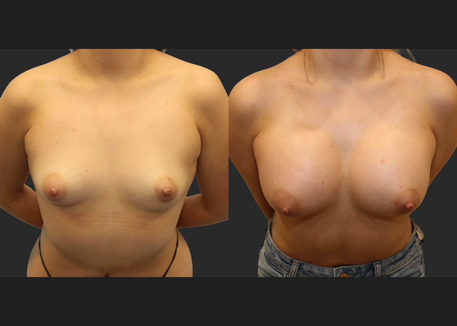 Breast Augmentation Saline Moderate profile 330 cc filled to 360 cc Subpectoral 6 weeks