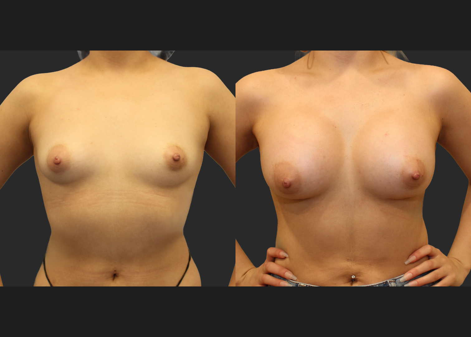 Breast Augmentation Saline Moderate profile 330 cc filled to 360 cc Subpectoral 6 weeks