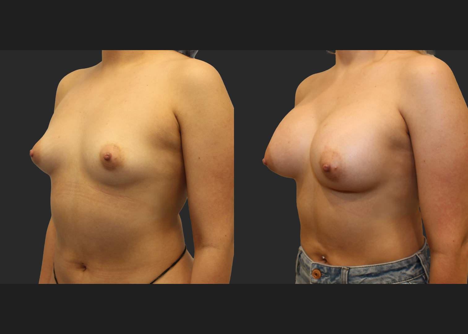 Breast Augmentation Saline Moderate profile 330 cc filled to 360 cc Subpectoral 6 weeks