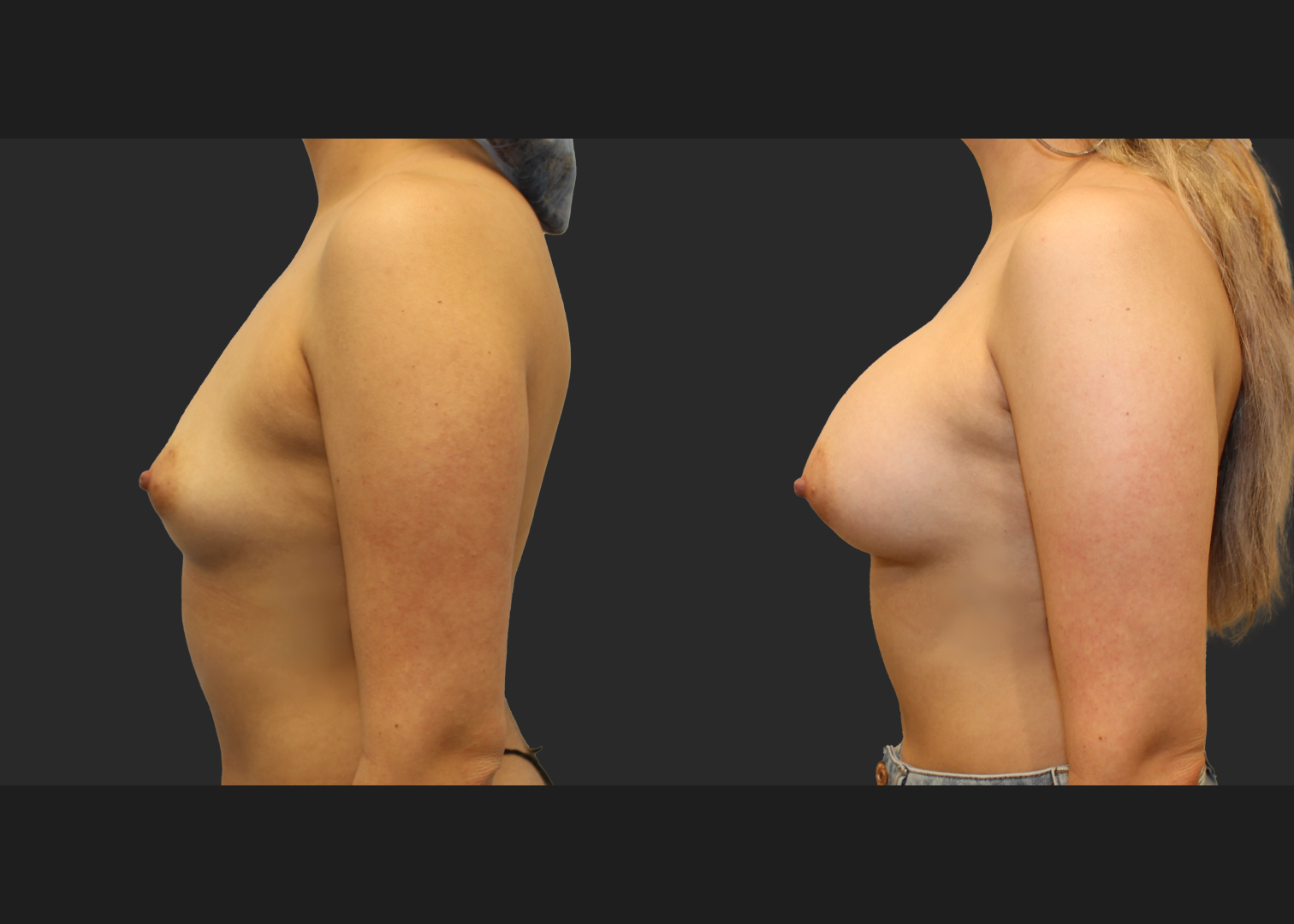 Breast Augmentation Saline Moderate profile 330 cc filled to 360 cc Subpectoral 6 weeks