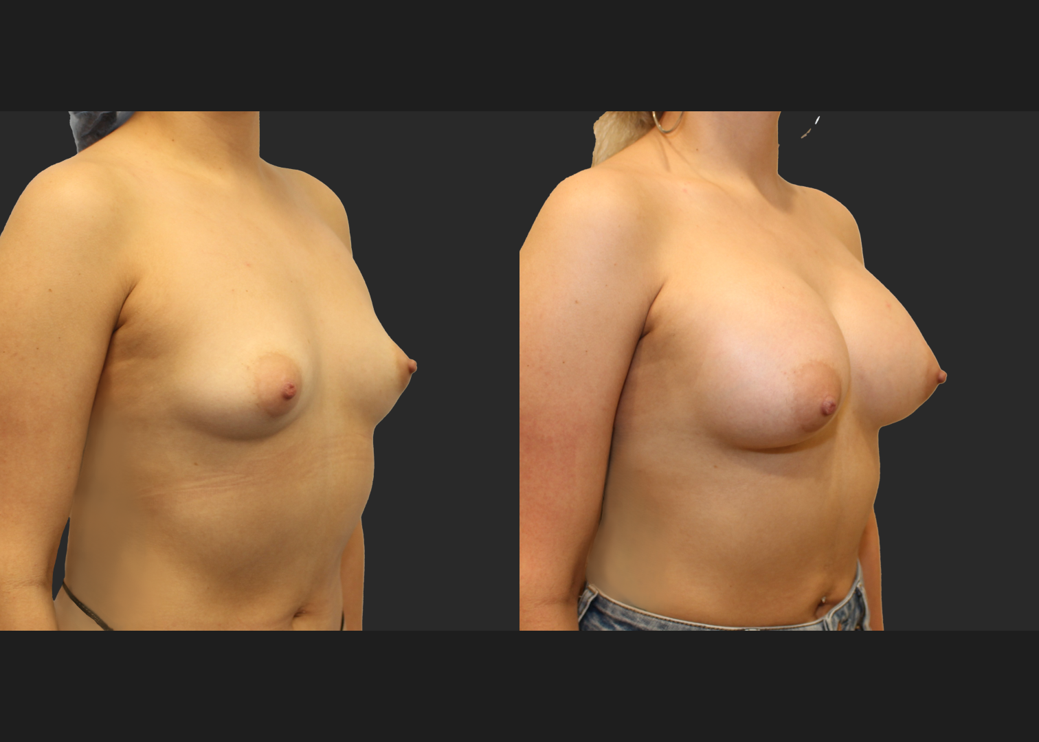Breast Augmentation Saline Moderate profile 330 cc filled to 360 cc Subpectoral 6 weeks