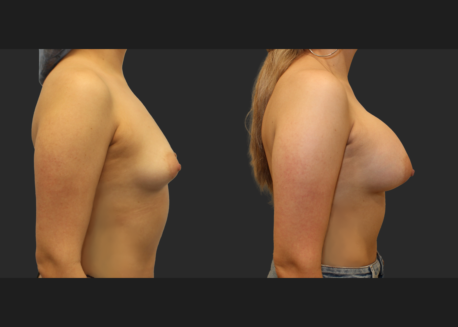 Breast Augmentation Saline Moderate profile 330 cc filled to 360 cc Subpectoral 6 weeks