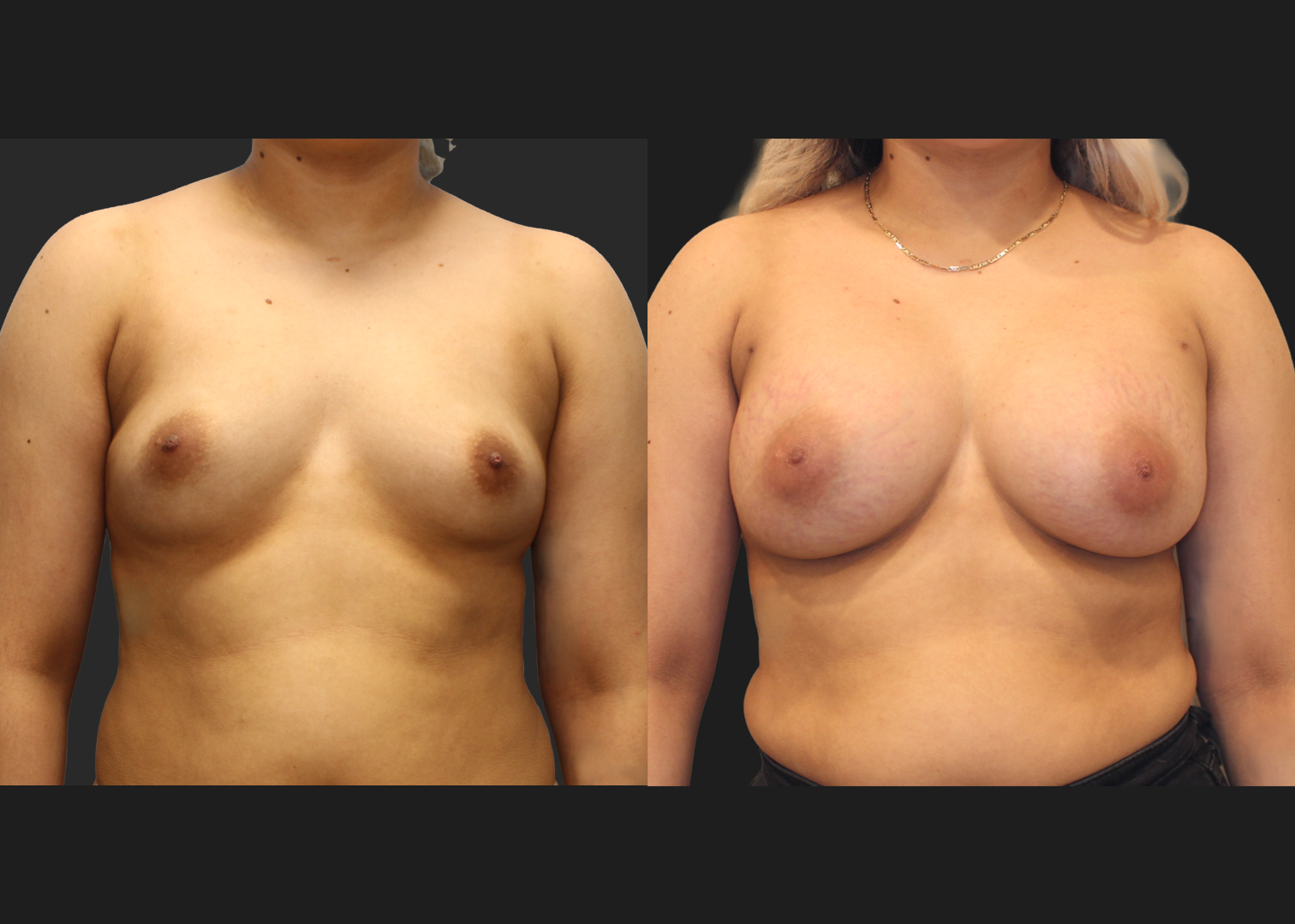 Breast Augmentation_Silicone_SRF 385cc_Subpectoral_Dual Plane I Pocket_Before and After 2 months_Flex