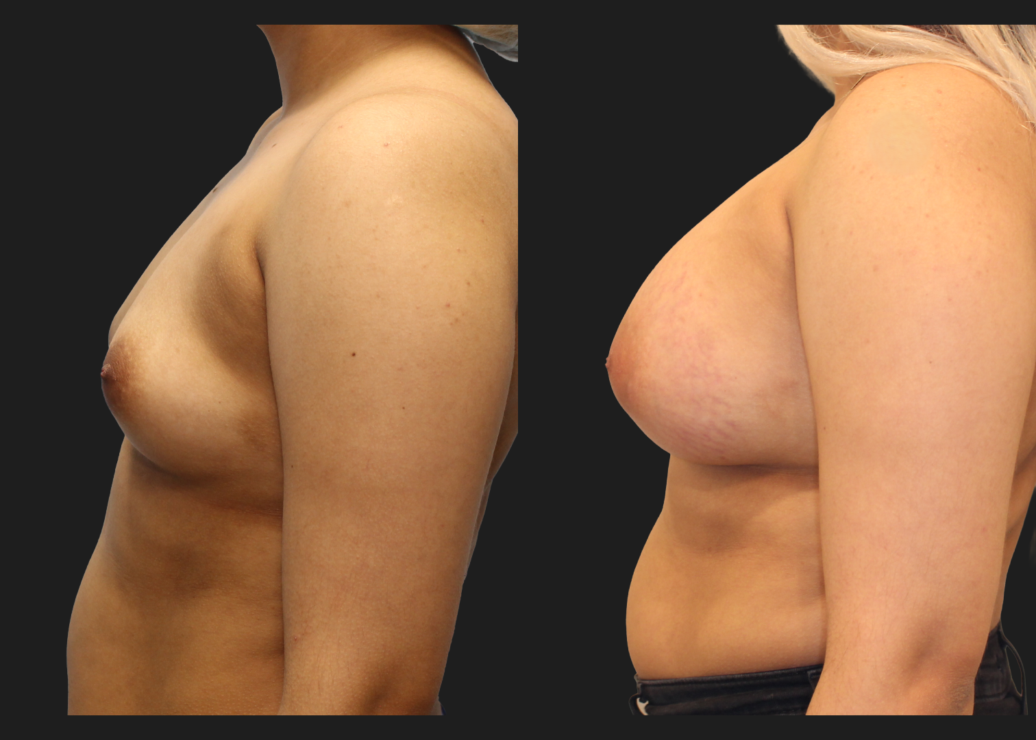Breast Augmentation_Silicone_SRF 385cc_Subpectoral_Dual Plane I Pocket_Before and After 2 months_Flex