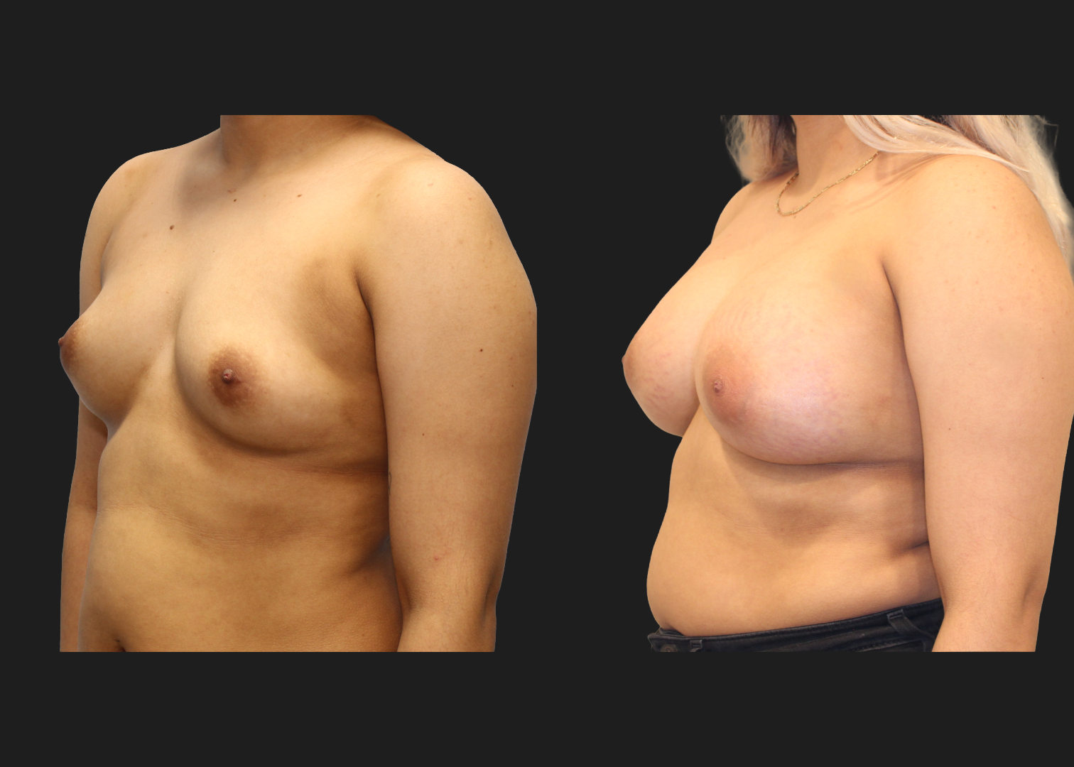Breast Augmentation_Silicone_SRF 385cc_Subpectoral_Dual Plane I Pocket_Before and After 2 months_Flex