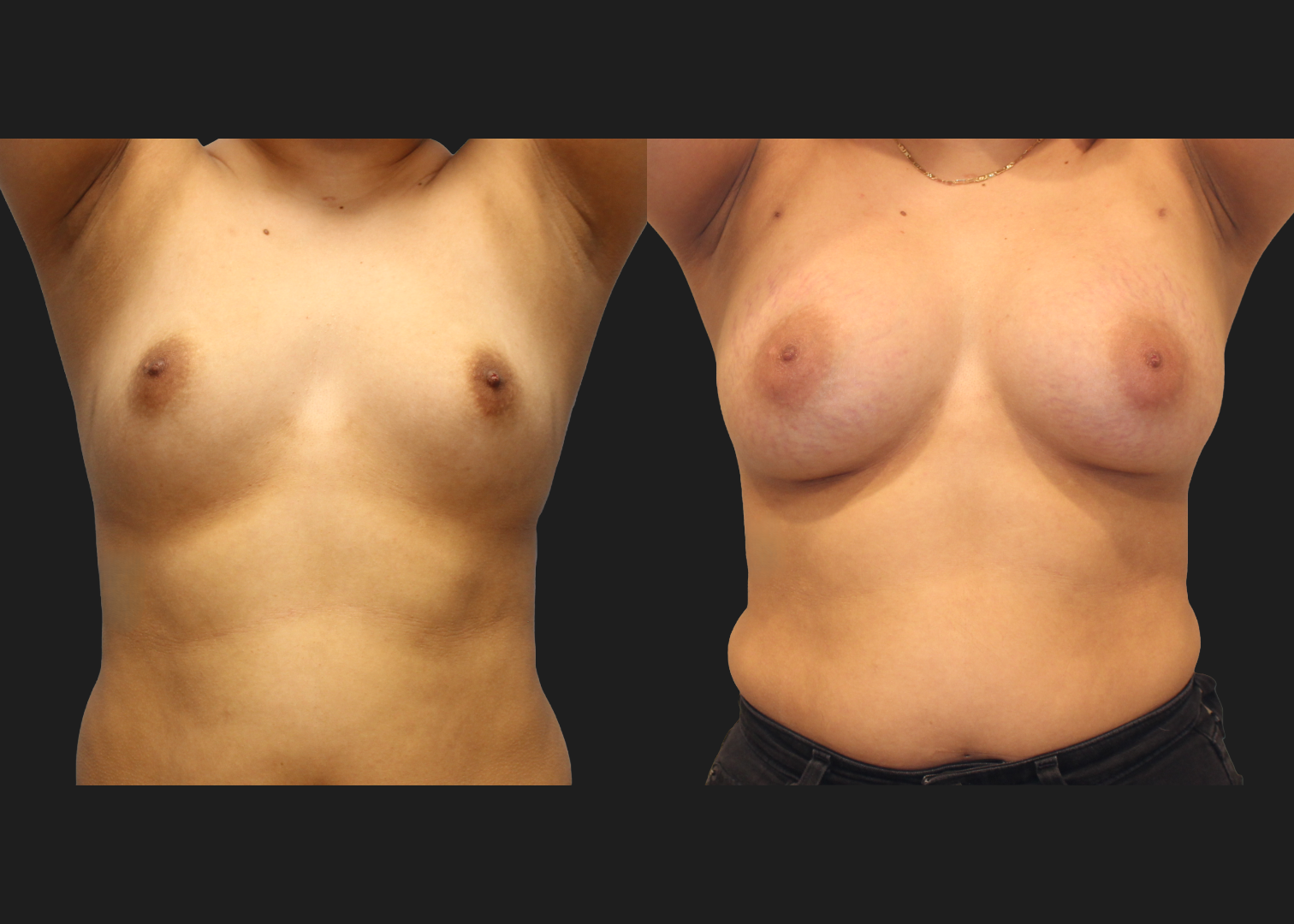 Breast Augmentation_Silicone_SRF 385cc_Subpectoral_Dual Plane I Pocket_Before and After 2 months_Flex