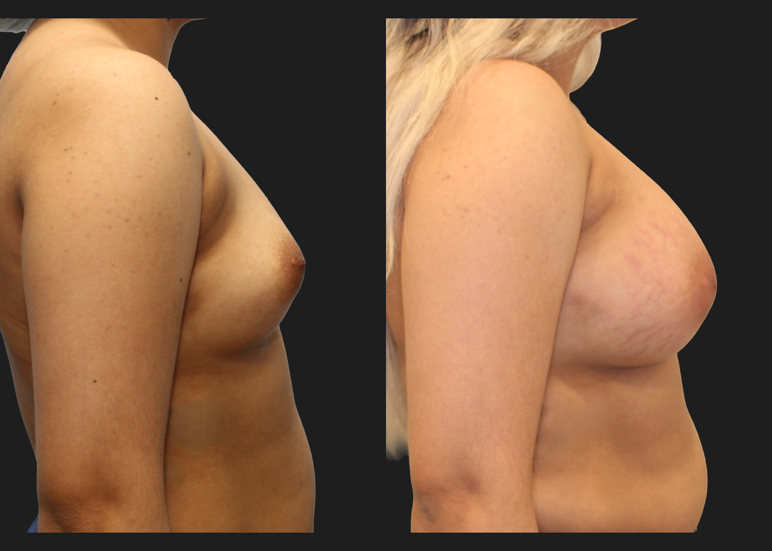 Breast Augmentation_Silicone_SRF 385cc_Subpectoral_Dual Plane I Pocket_Before and After 2 months_Flex