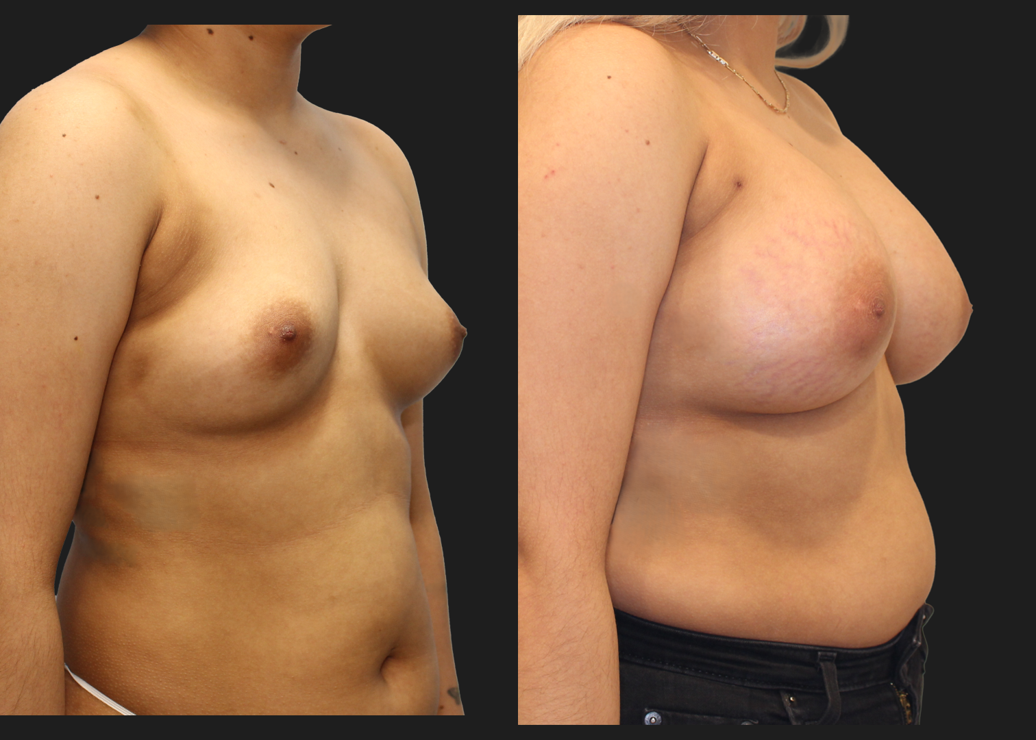 Breast Augmentation_Silicone_SRF 385cc_Subpectoral_Dual Plane I Pocket_Before and After 2 months_Flex